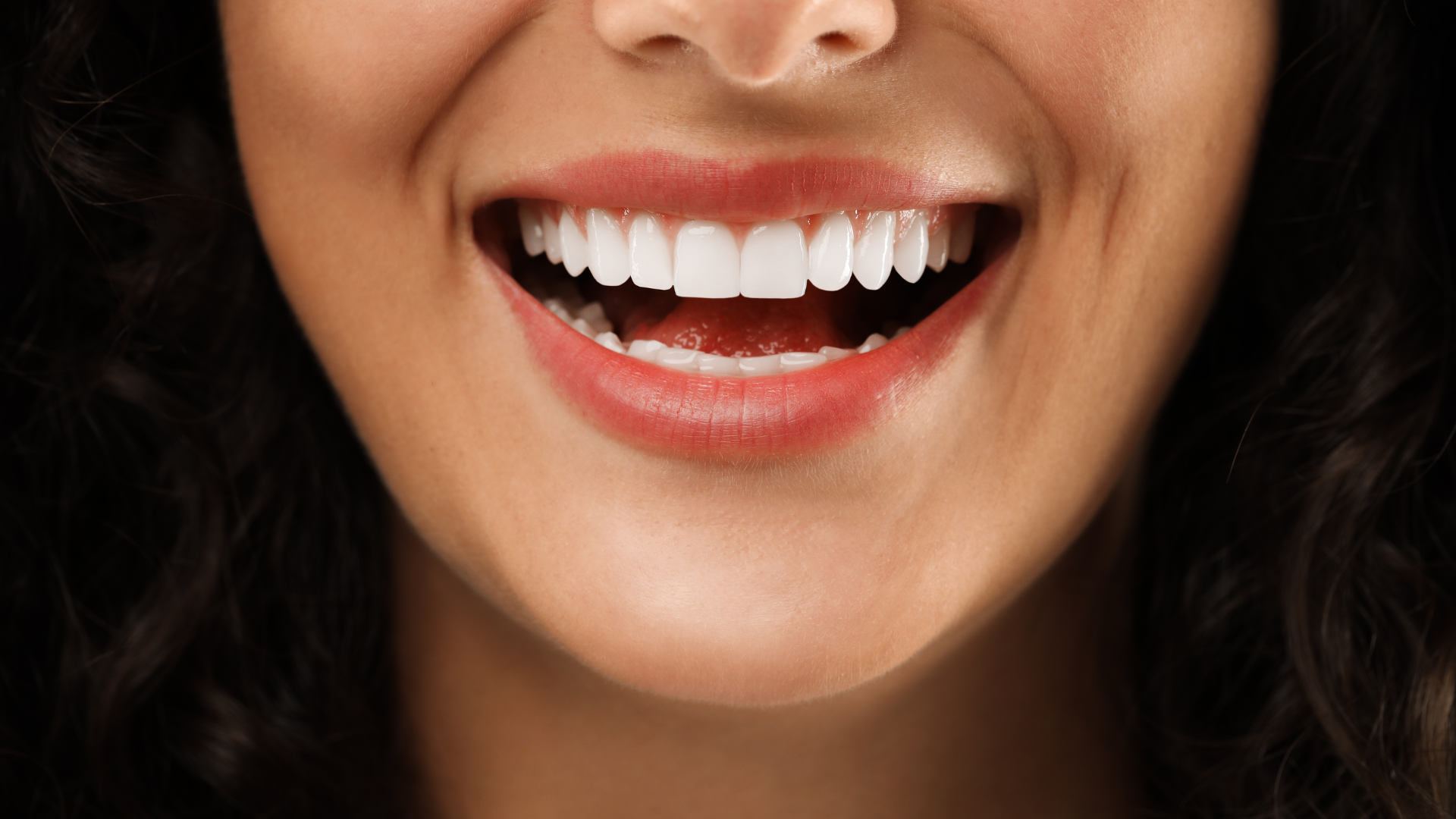 Carillas Dentales